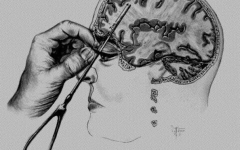 Instant Lobotomy
